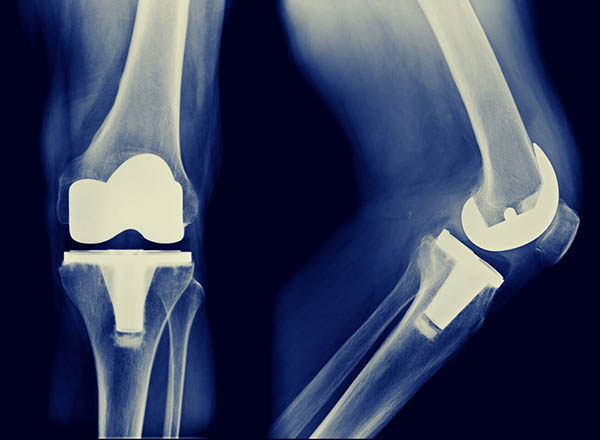 X-ray of knees